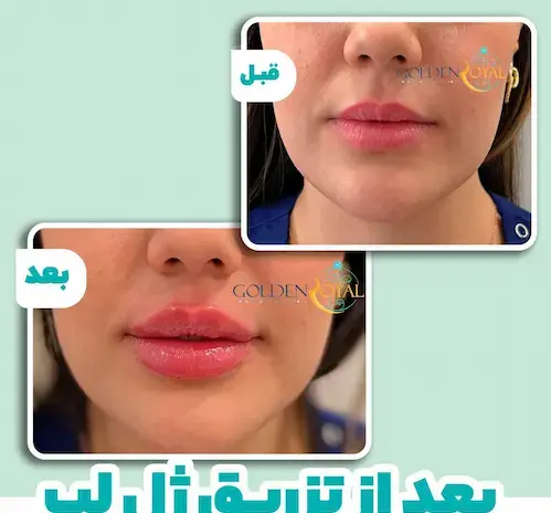 عکس قبل و بعد از تزریق ژل لب