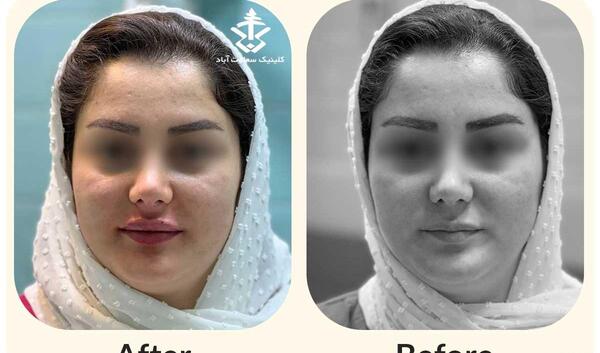 عکس قبل و بعد از تزریق ژل لب