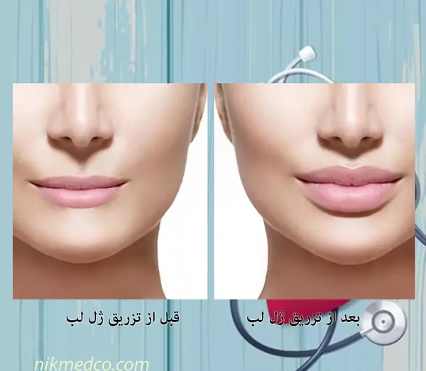 عکس قبل و بعد از تزریق ژل لب
