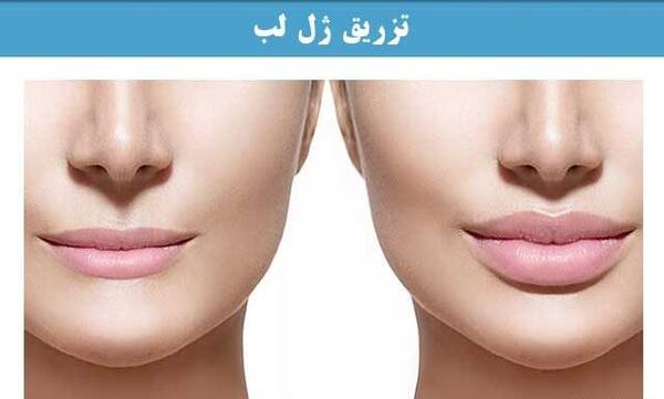 عکس قبل و بعد از تزریق ژل لب