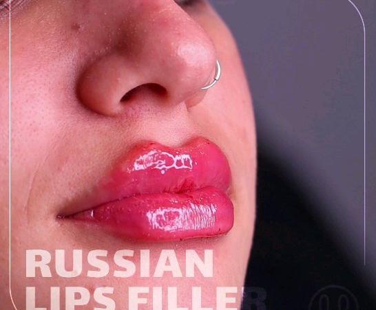 عکس قبل و بعد از تزریق ژل لب