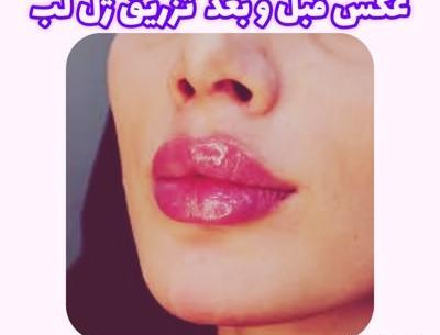 عکس قبل و بعد از تزریق ژل لب