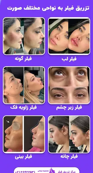 عکس قبل و بعد از تزریق ژل گونه