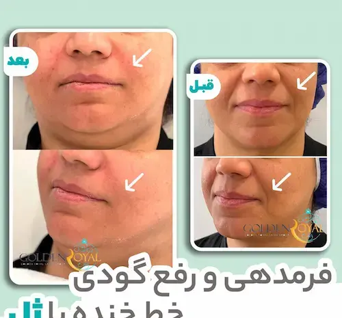 عکس قبل و بعد از تزریق ژل گونه