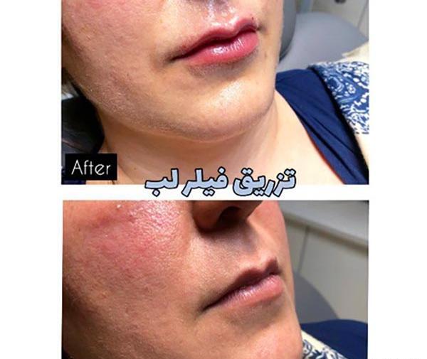 عکس قبل و بعد از تزریق ژل گونه