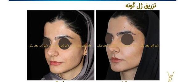 عکس قبل و بعد از تزریق ژل گونه
