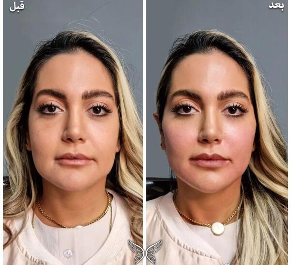 عکس قبل و بعد از تزریق ژل گونه