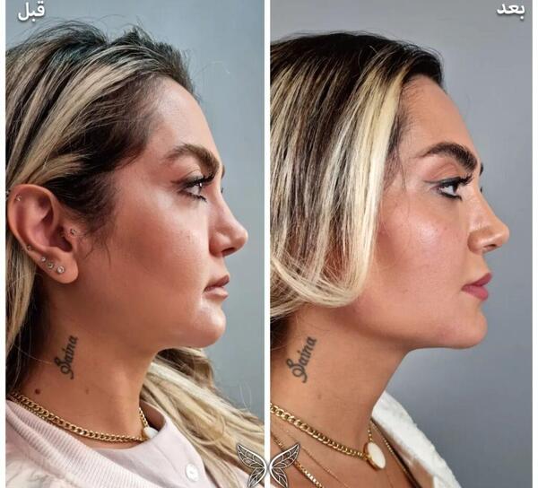 عکس قبل و بعد از تزریق ژل گونه