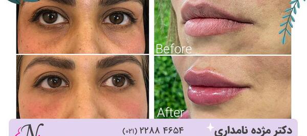 عکس قبل و بعد تزریق ژل به گونه