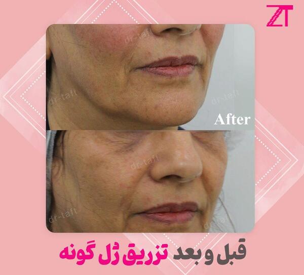 عکس قبل و بعد تزریق ژل به گونه