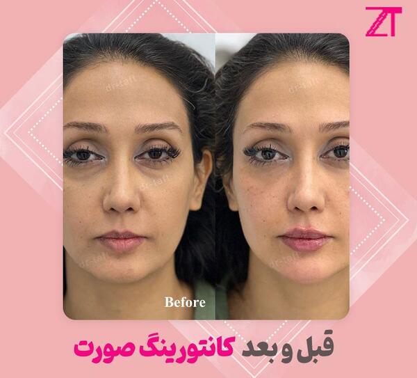 عکس قبل و بعد تزریق ژل به گونه
