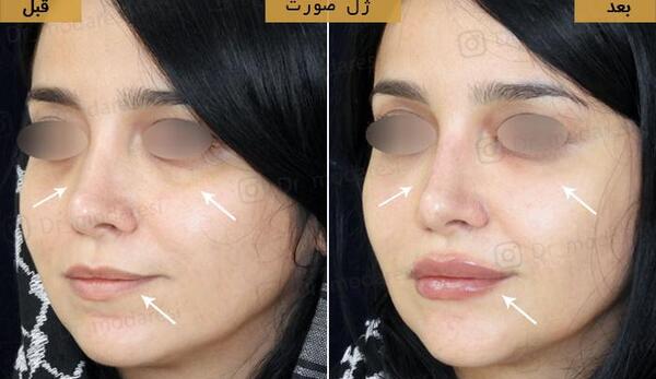 عکس قبل و بعد تزریق ژل به گونه