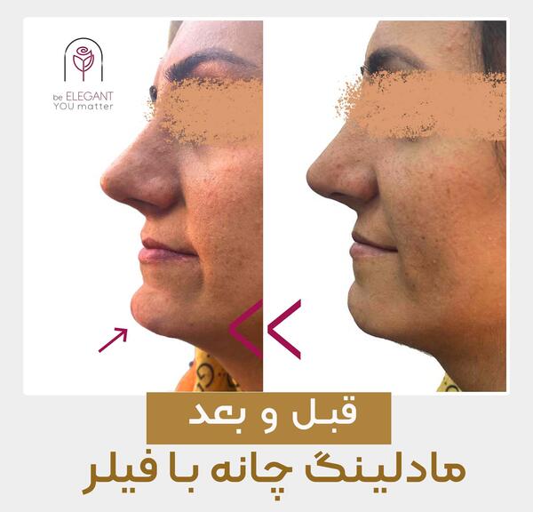 عکس قبل و بعد تزریق ژل به گونه