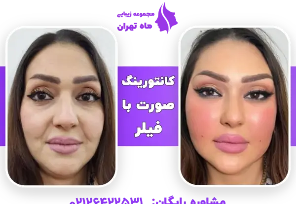 عکس قبل و بعد تزریق ژل به گونه