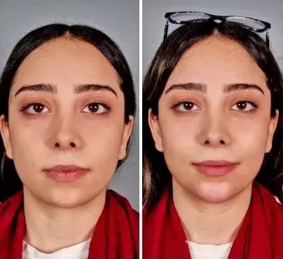 عکس قبل و بعد تزریق ژل به گونه