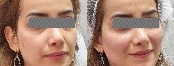 عکس قبل و بعد تزریق ژل به گونه