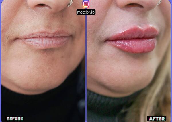 عکس قبل و بعد تزریق ژل به گونه