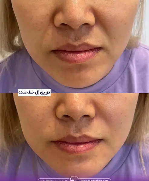 عکس قبل و بعد تزریق ژل خط خنده