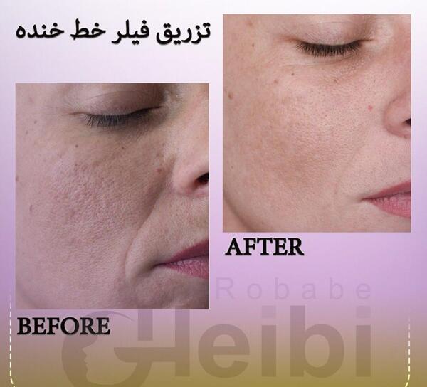 عکس قبل و بعد تزریق ژل خط خنده