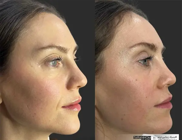 عکس قبل و بعد تزریق ژل خط خنده