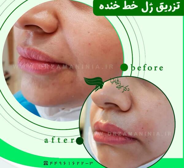 عکس قبل و بعد تزریق ژل خط خنده