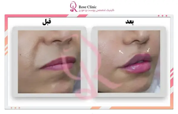 عکس قبل و بعد تزریق ژل خط خنده