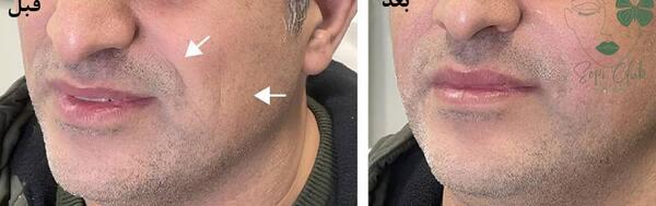عکس قبل و بعد تزریق ژل خط خنده