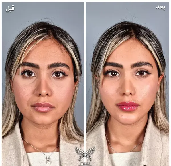 عکس قبل و بعد تزریق ژل خط خنده