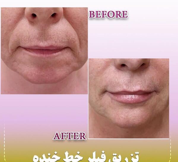 عکس قبل و بعد تزریق ژل خط خنده
