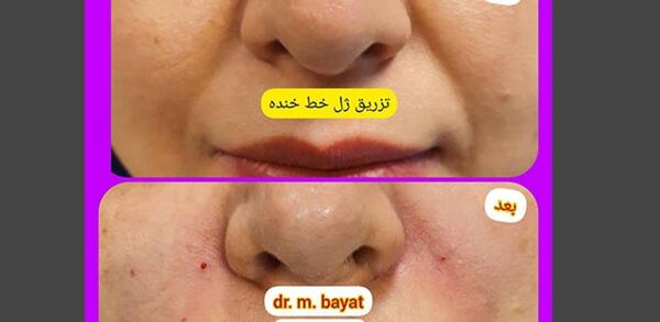 عکس قبل و بعد تزریق ژل خط خنده