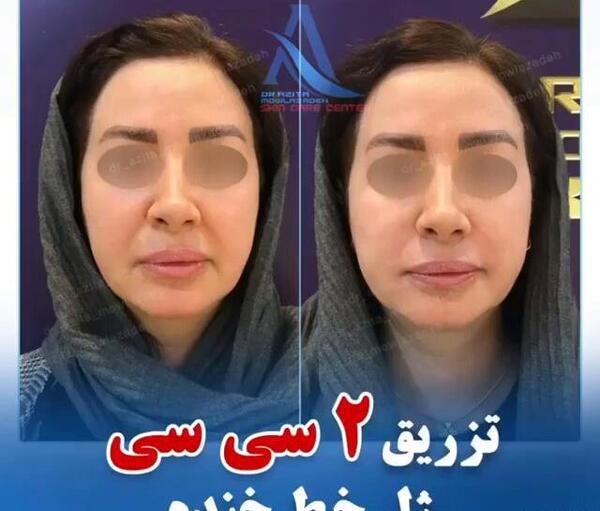 عکس قبل و بعد تزریق ژل خط خنده