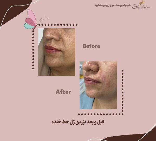 عکس قبل و بعد تزریق ژل خط خنده
