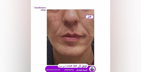 عکس قبل و بعد تزریق ژل خط خنده