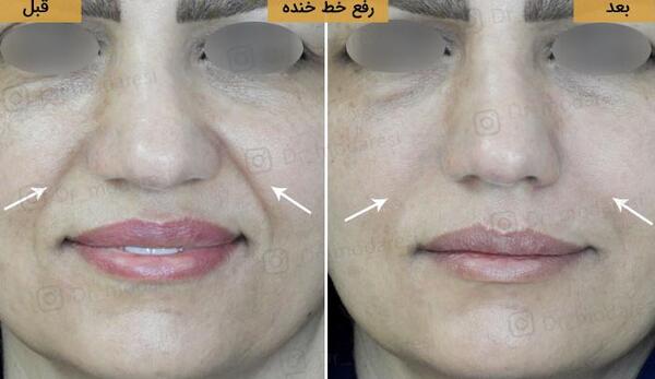 عکس قبل و بعد تزریق ژل خط خنده