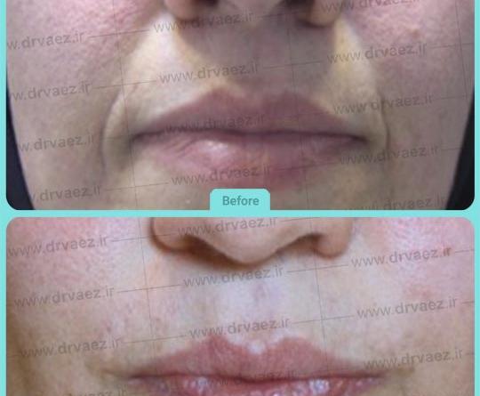 عکس قبل و بعد تزریق ژل خط خنده