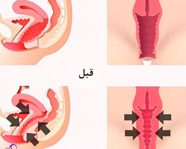 عکس قبل و بعد تزریق ژل به واژن
