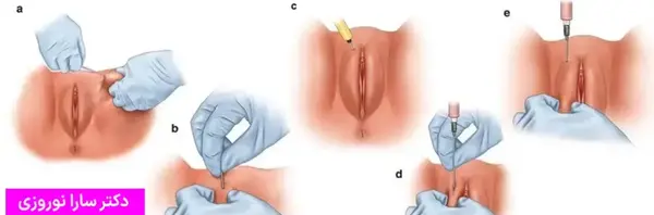 عکس قبل و بعد تزریق ژل به واژن
