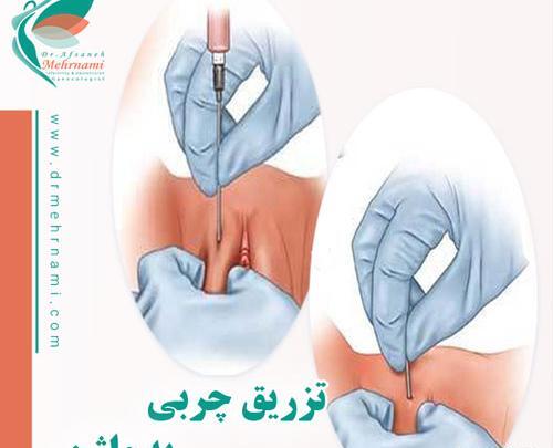 عکس قبل و بعد تزریق ژل به واژن