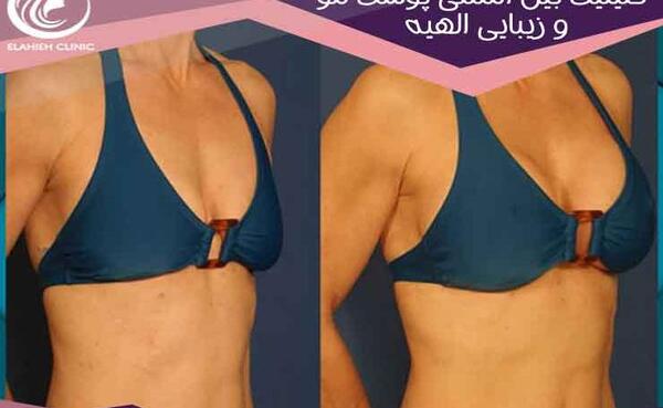 عکس قبل و بعد تزریق ژل به واژن