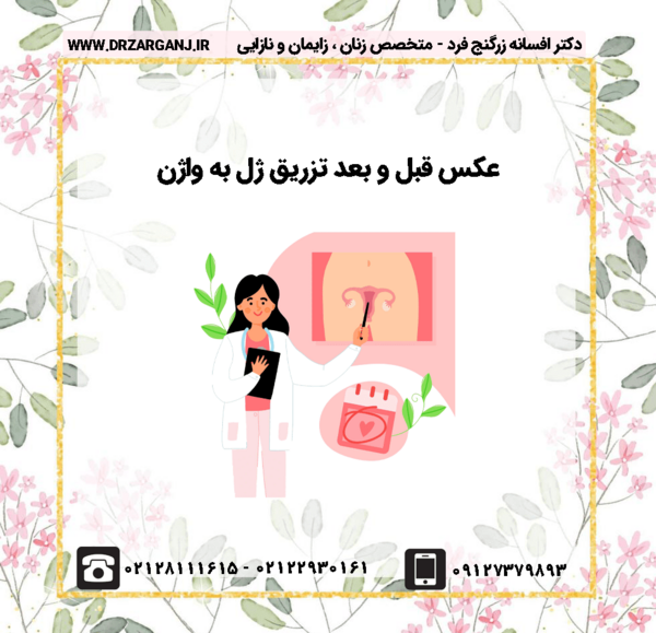 عکس قبل و بعد تزریق ژل به واژن