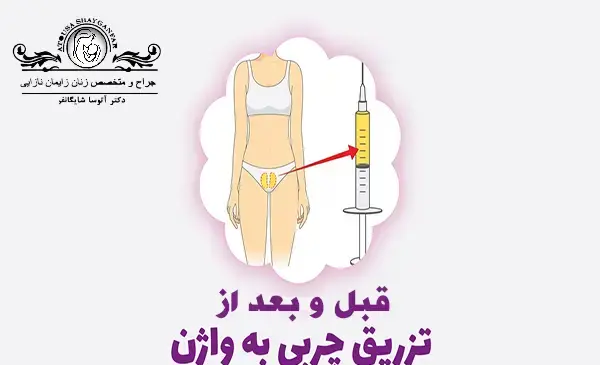 عکس قبل و بعد تزریق ژل به واژن
