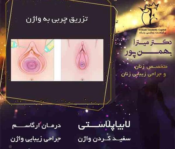 عکس قبل و بعد تزریق ژل به واژن