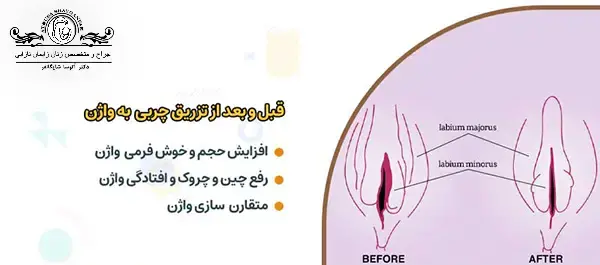عکس قبل و بعد تزریق ژل به واژن