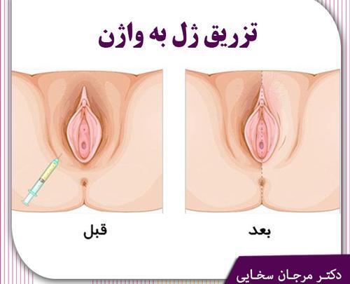 عکس قبل و بعد تزریق ژل به واژن