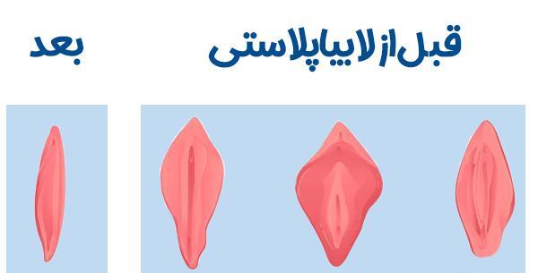 عکس قبل و بعد تزریق ژل به واژن