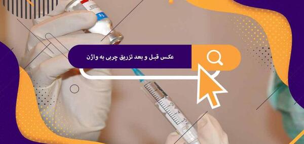 عکس قبل و بعد تزریق ژل به واژن نی نی سایت