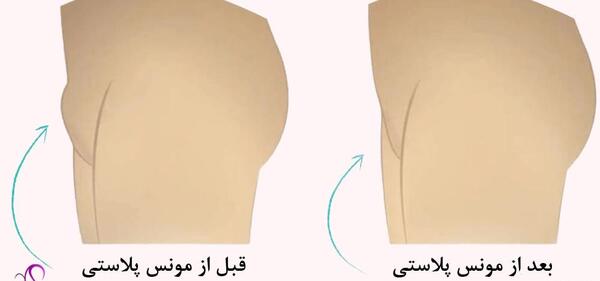عکس قبل و بعد تزریق ژل به واژن نی نی سایت