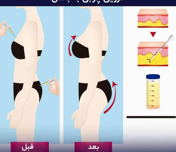 عکس قبل و بعد تزریق ژل به واژن نی نی سایت