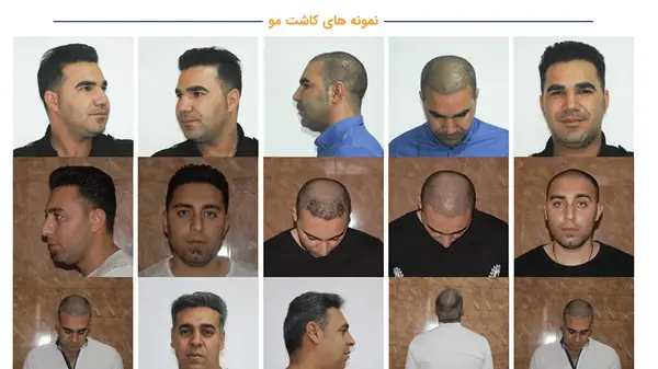 عکس قبل کاشت مو علی قلی زاده