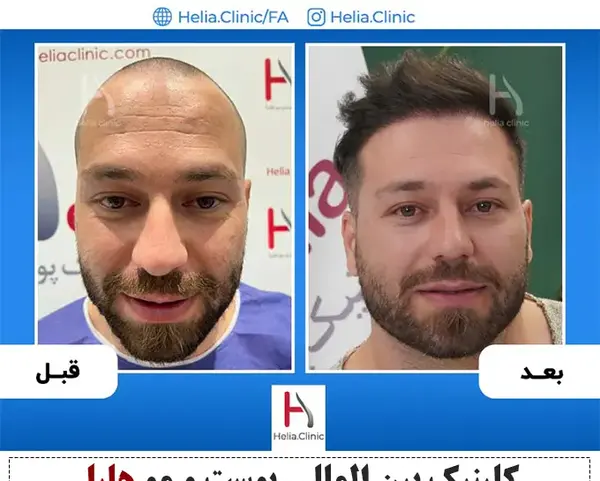 عکس قبل کاشت مو علی قلی زاده